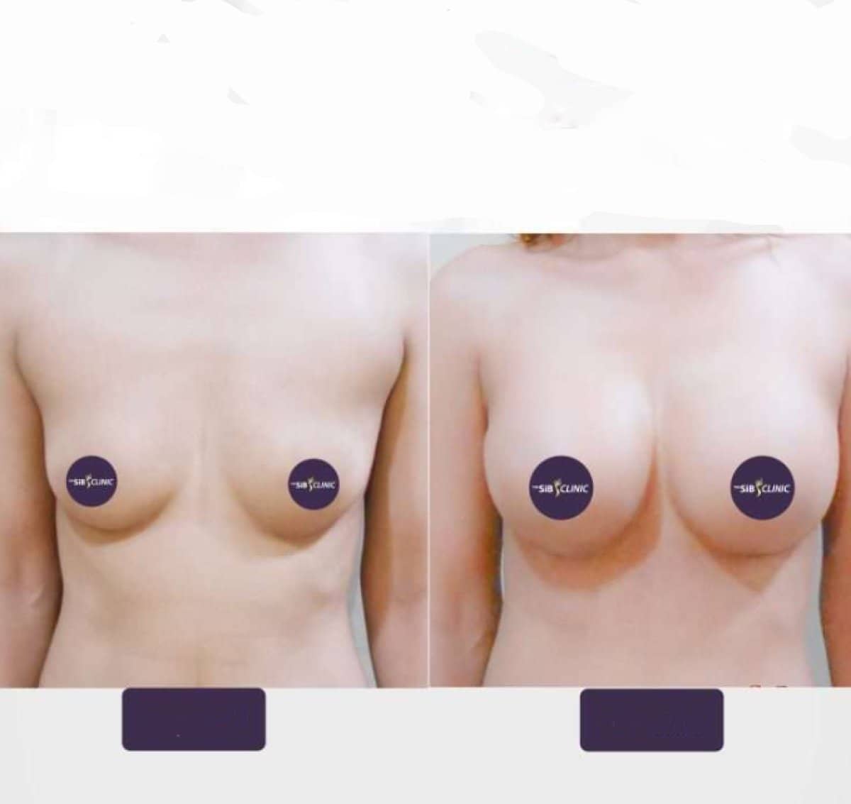 Case 14649 - breast augmentation