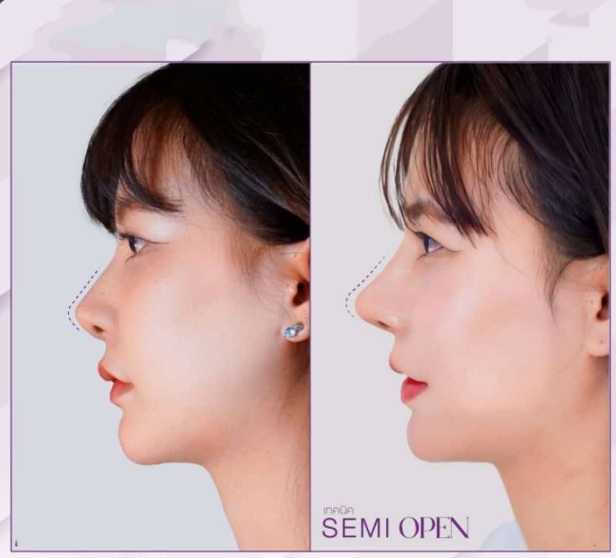 Case 14650 - revision rhinoplasty