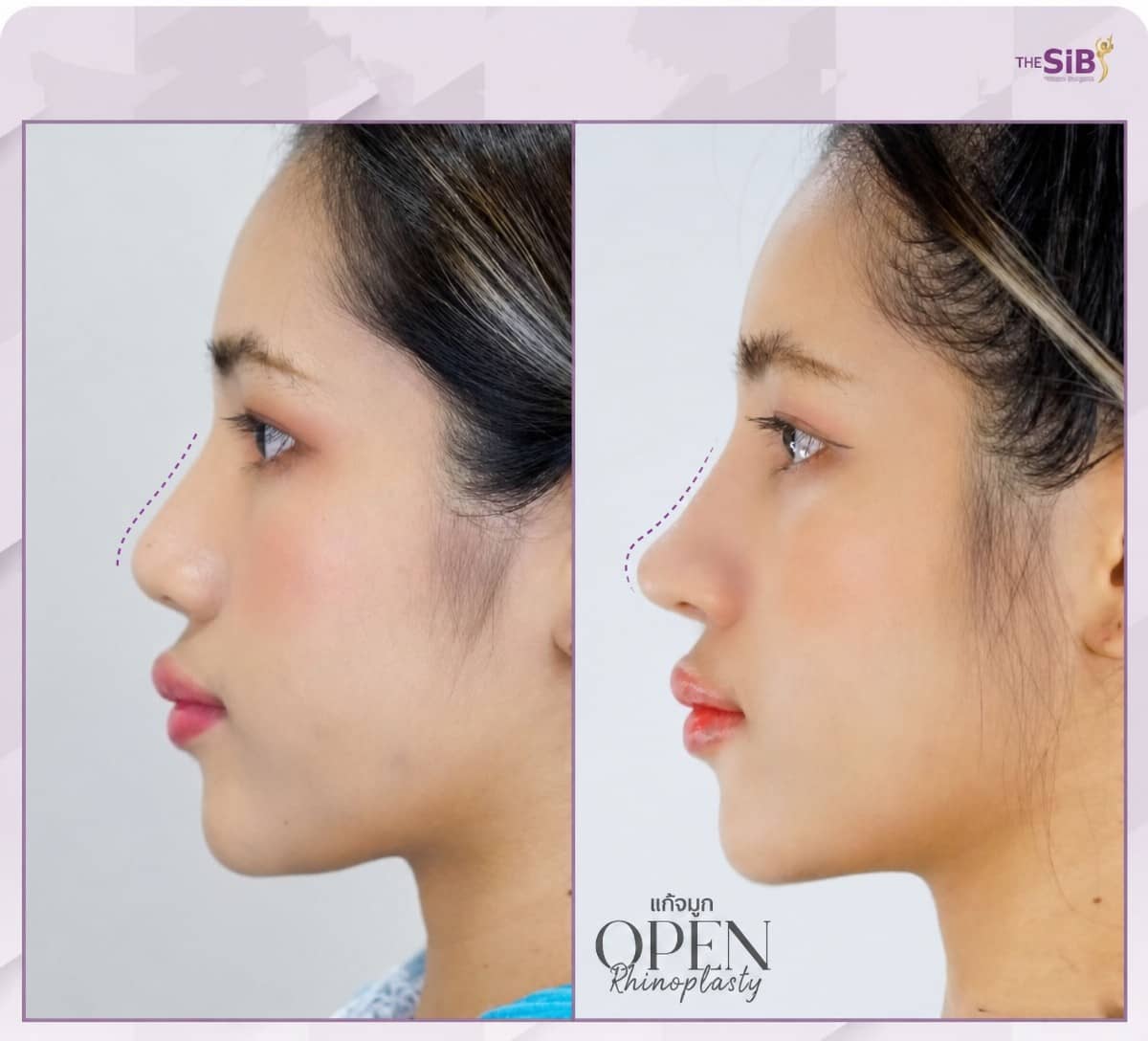Case 14651 - revision rhinoplasty