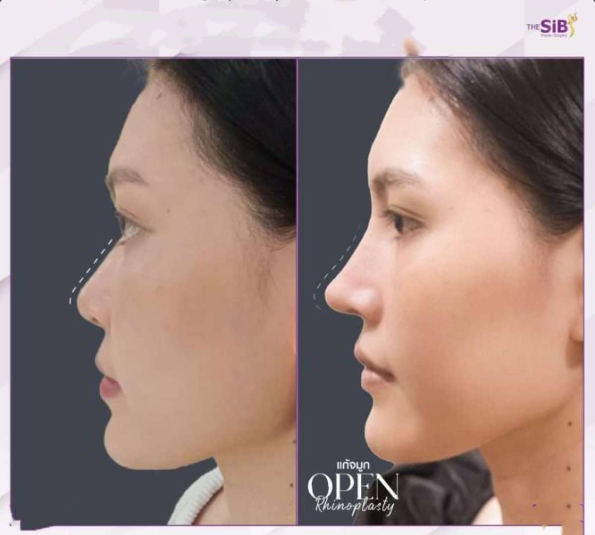 Case 14652 - rhinoplasty