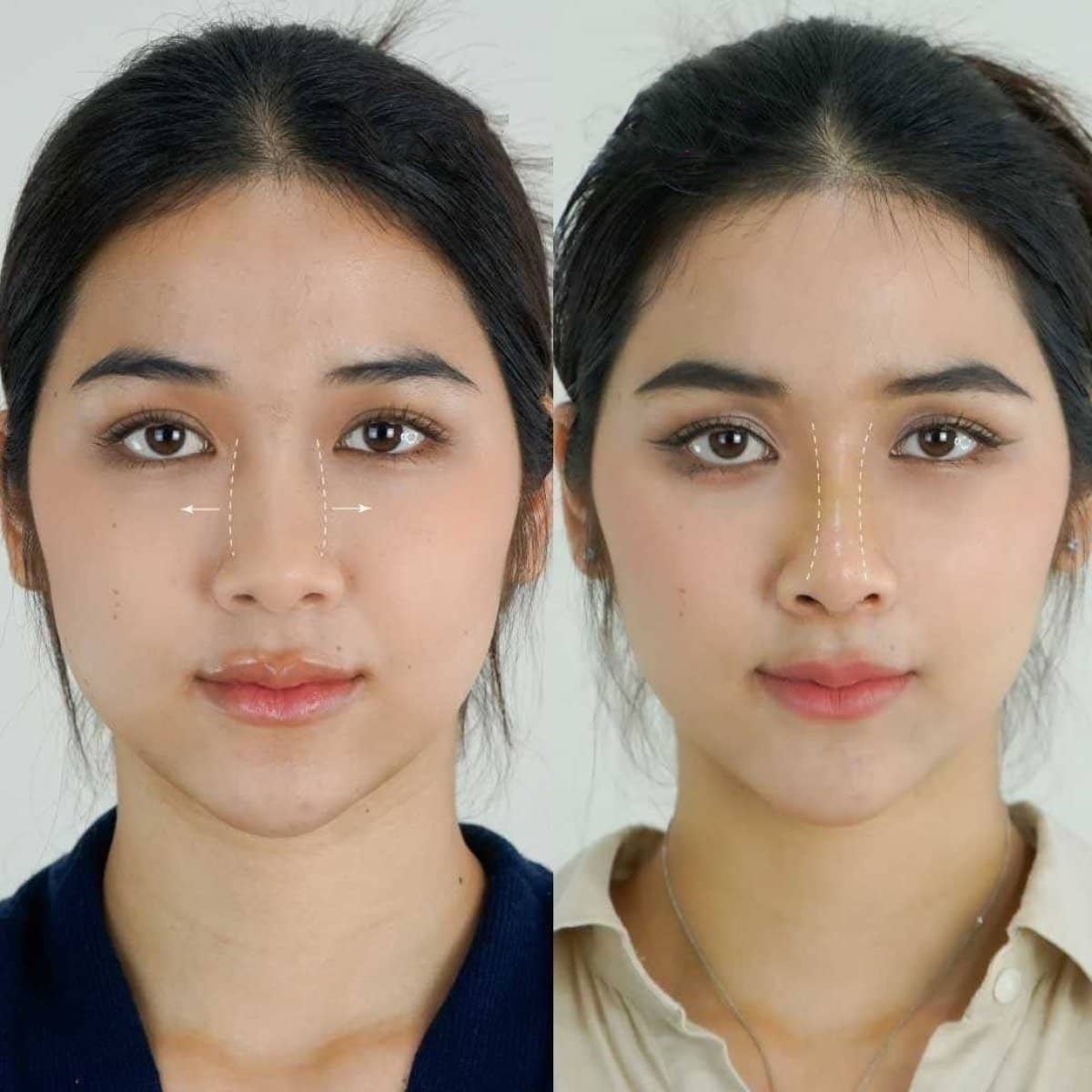 Case 14653 - open rhinoplasty