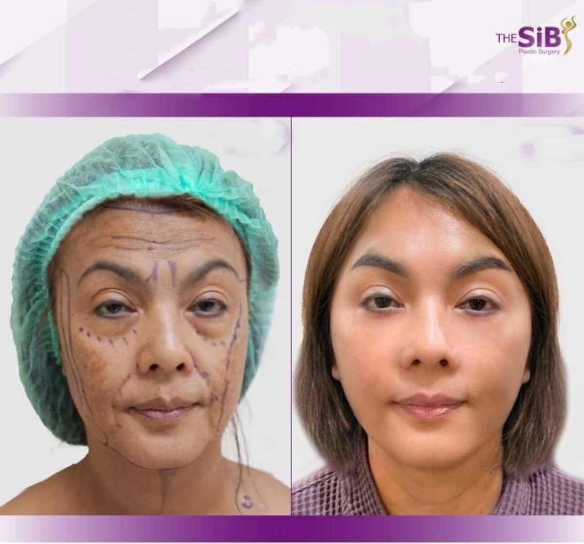 Case 14655 - facelift