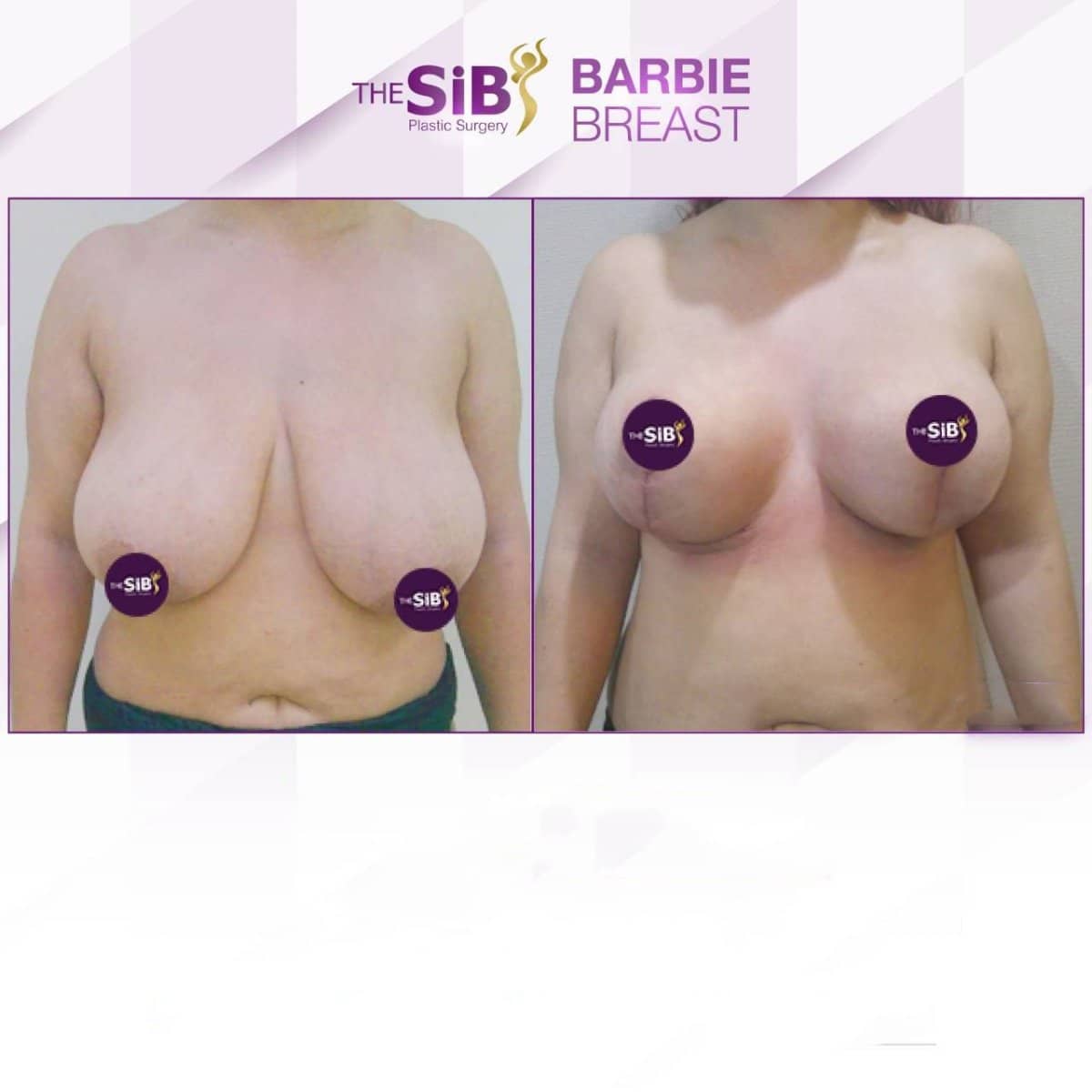 Case 14656 - breast lift