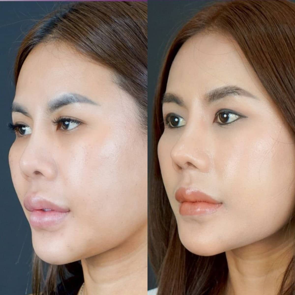Case 14657 - open rhinoplasty