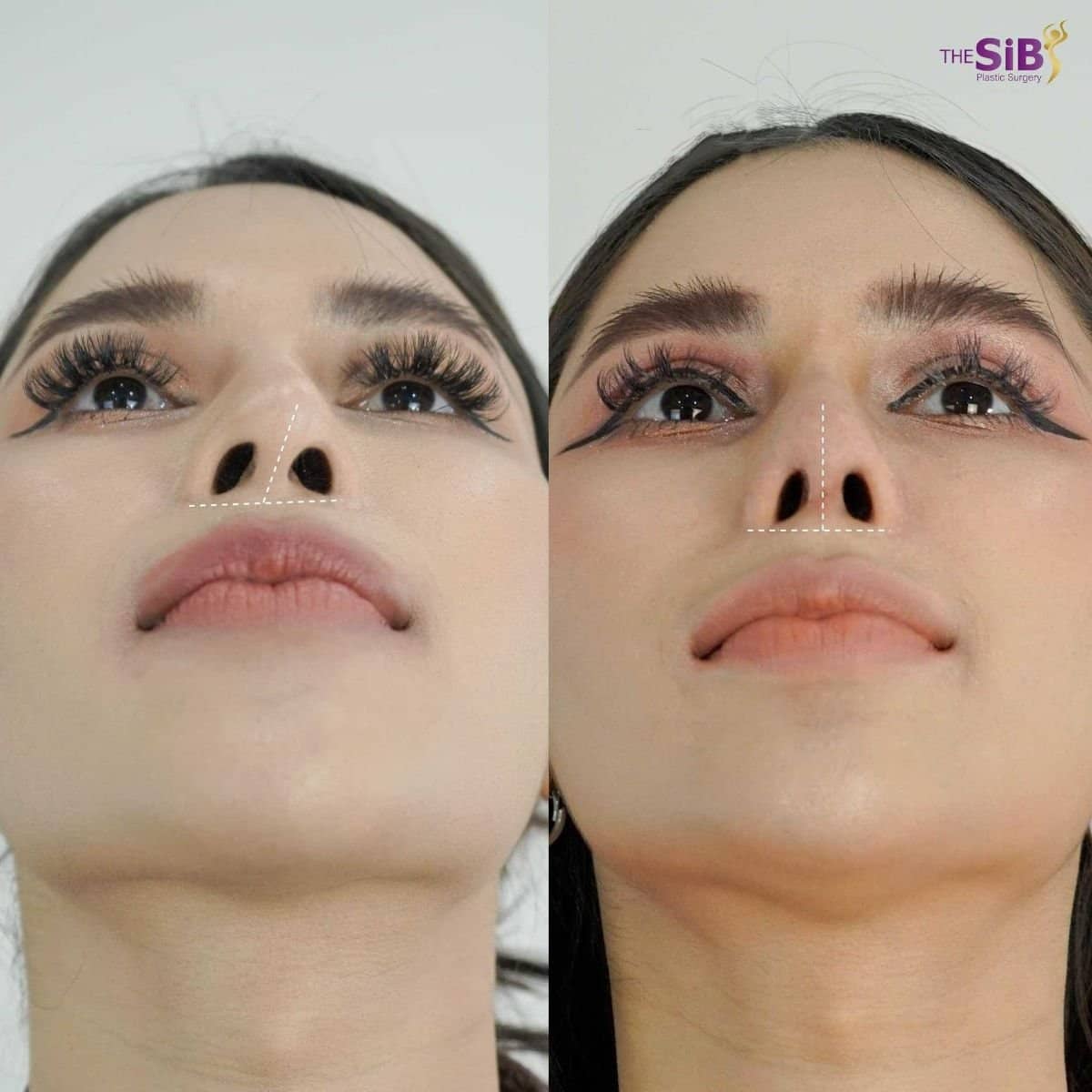 Case 14661 - open rhinoplasty