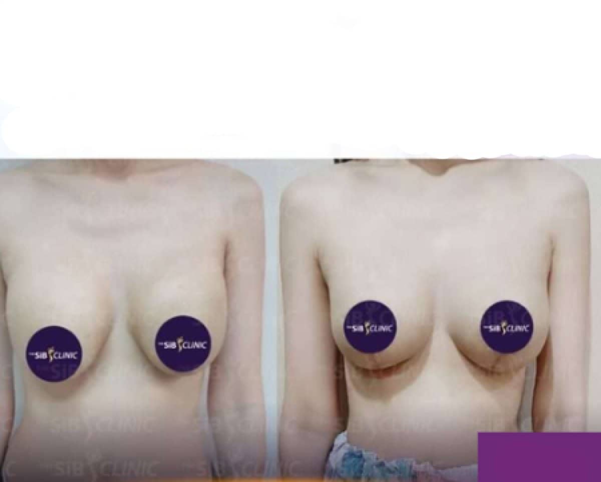Case 14662 - breast lift