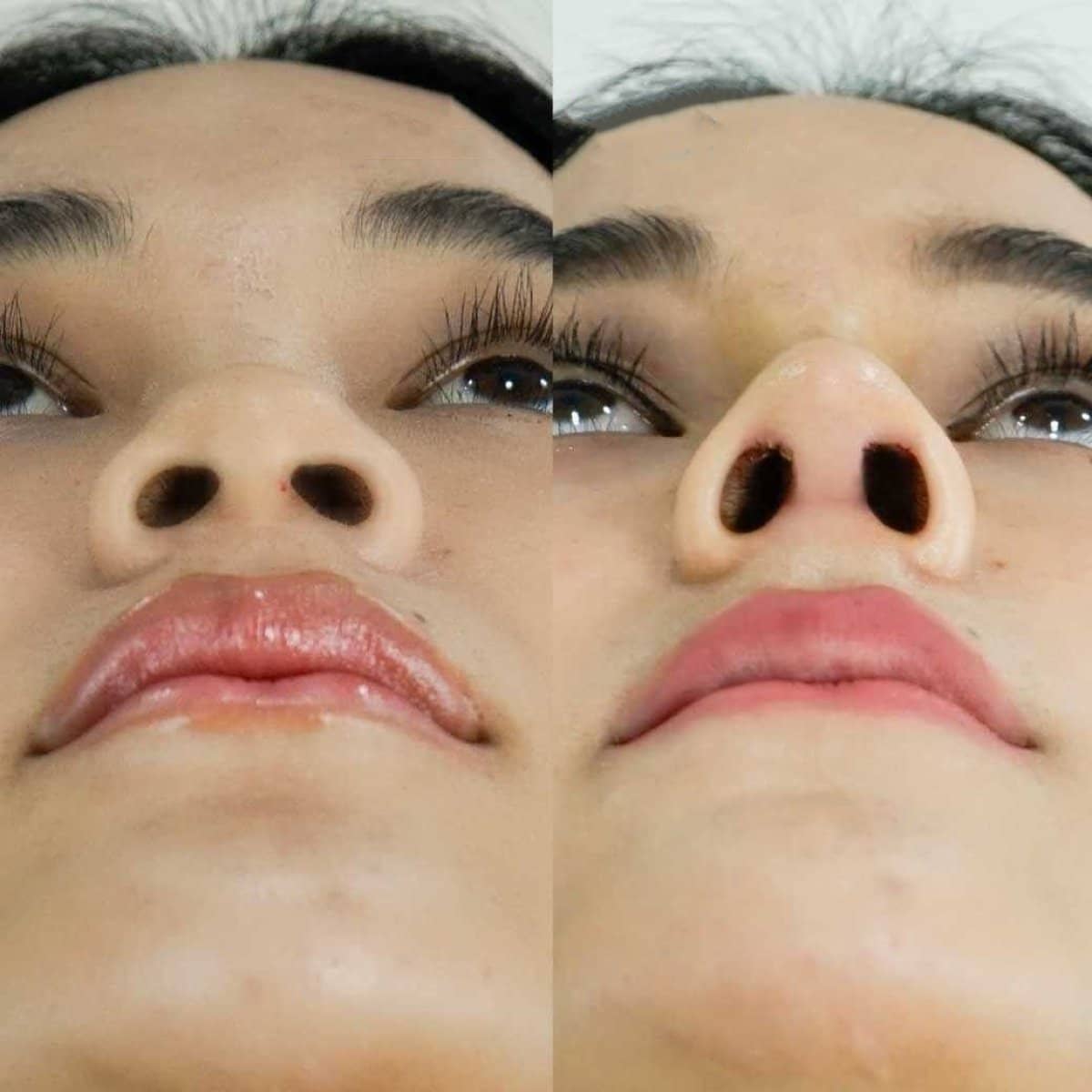 Case 14663 - open rhinoplasty