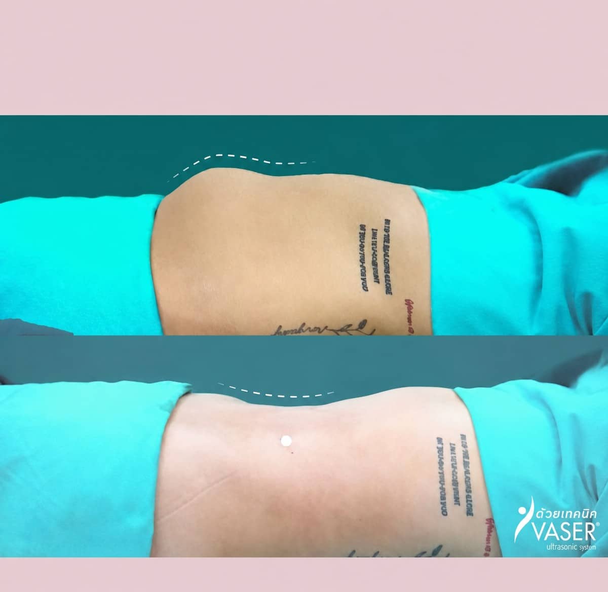Case 14665 - liposuction