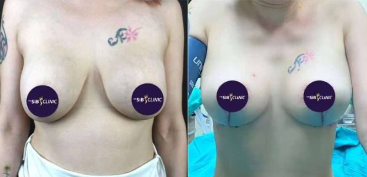 Case 14670 - breast lift