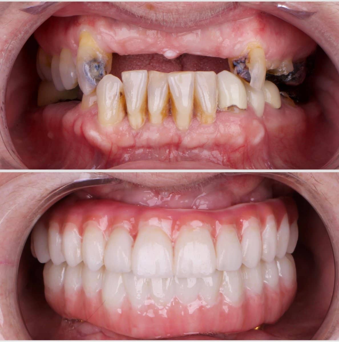 Case 14679 - All-on-4 dental implants