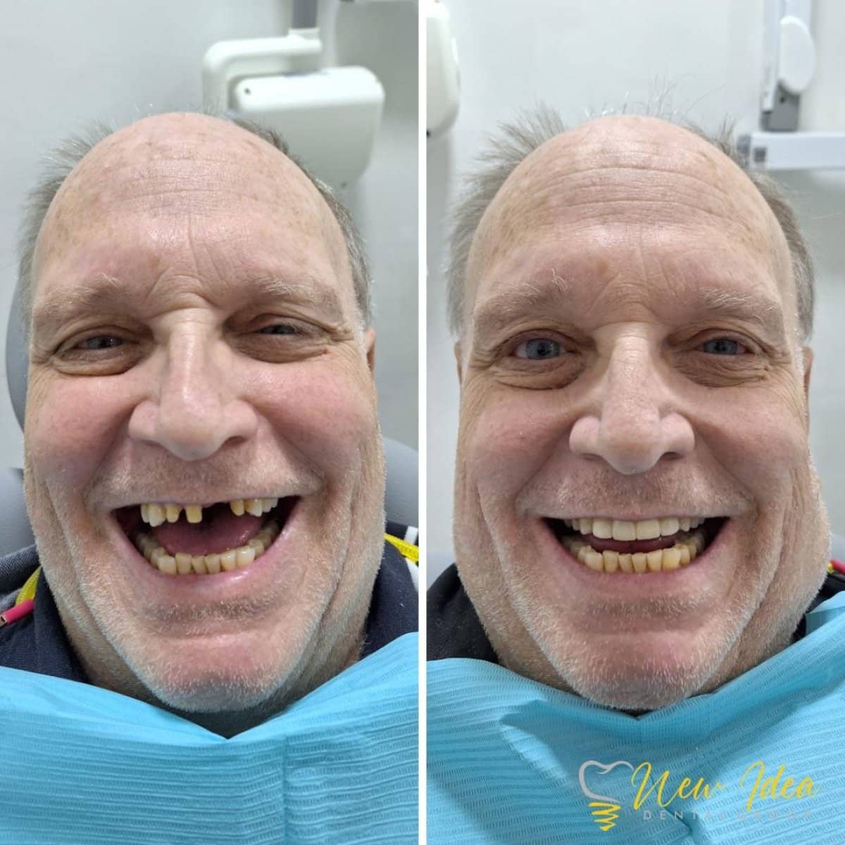 Case 14689 - mini dental implant