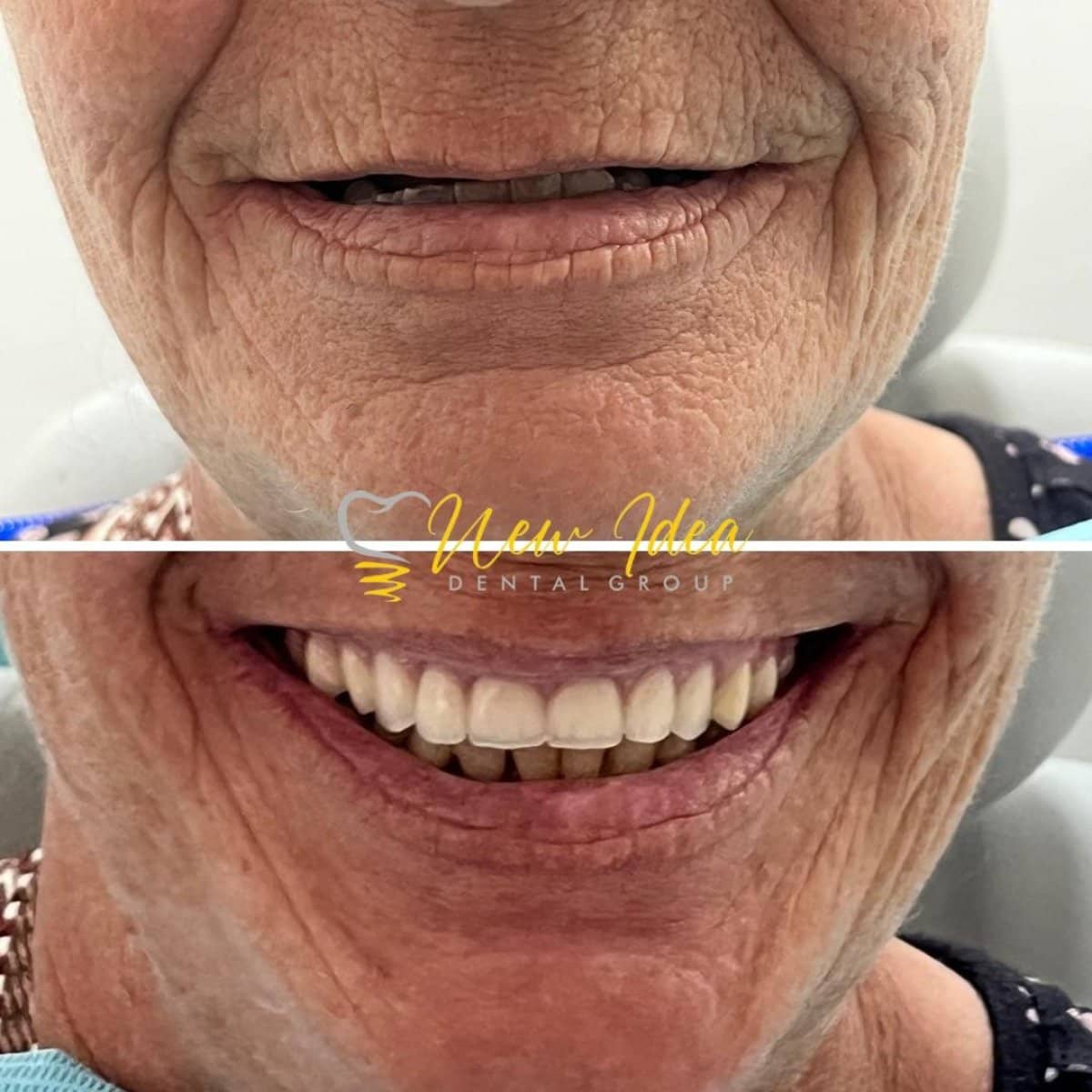 Case 14690 - mini dental implant
