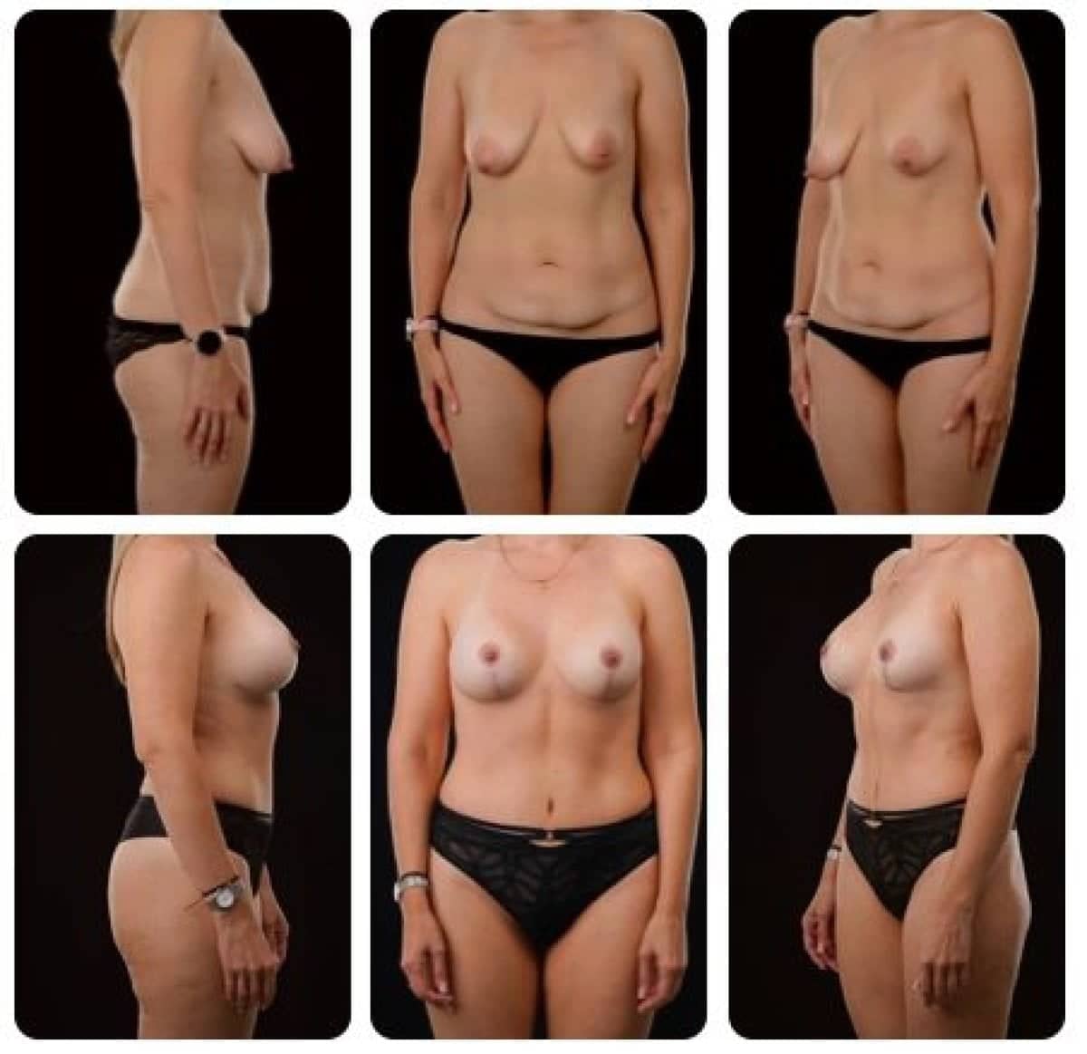 Case 14694 - breast lift