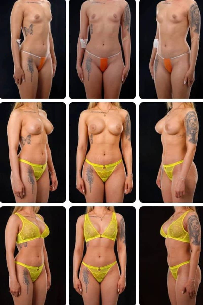 Case 14695 - breast augmentation