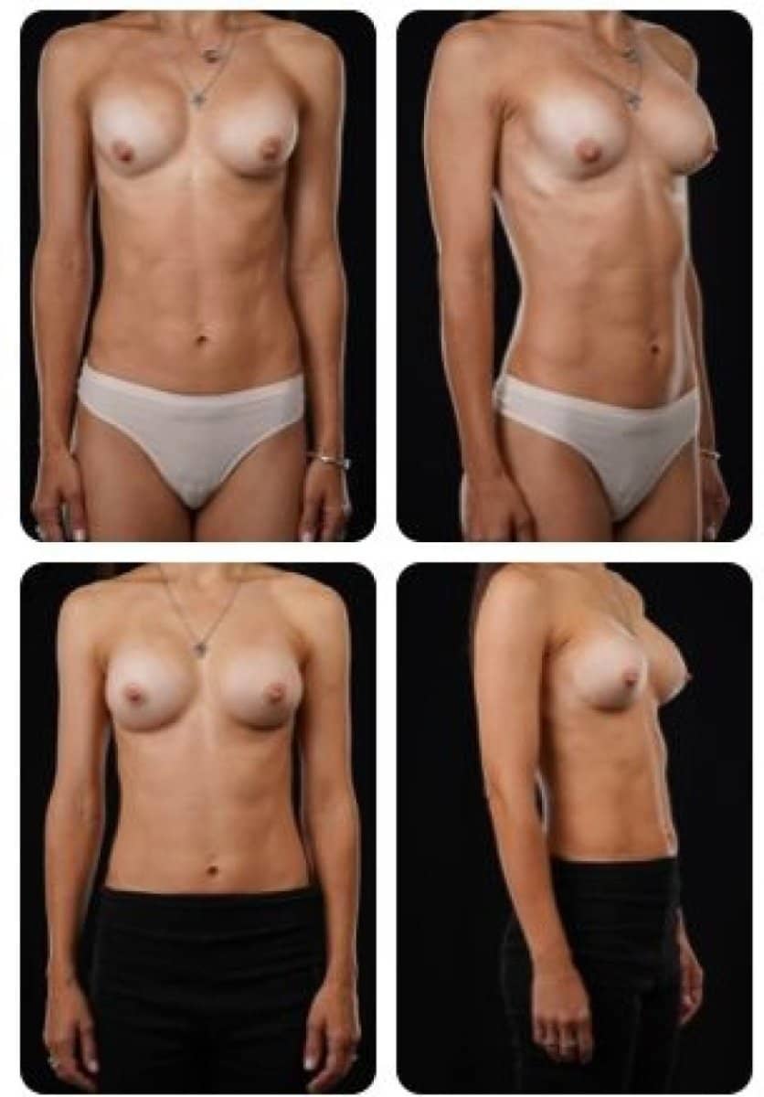 Case 14696 - breast augmentation