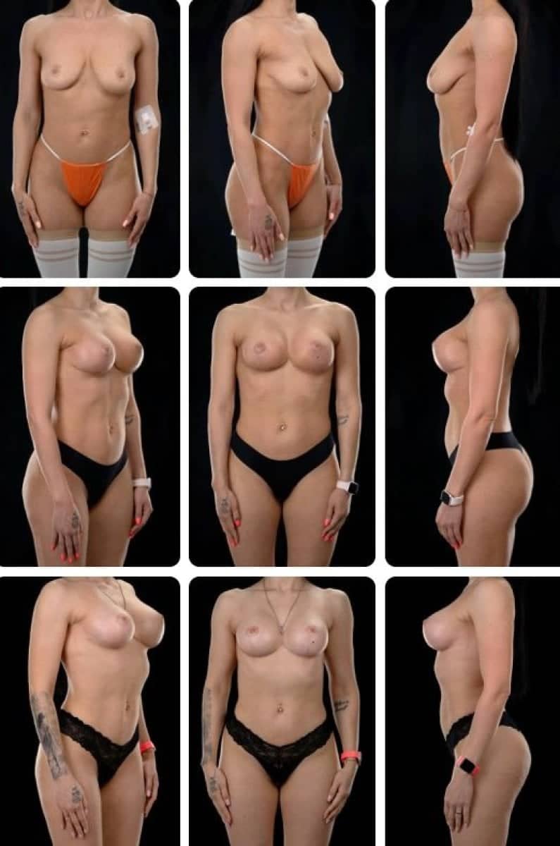 Case 14697 - breast lift