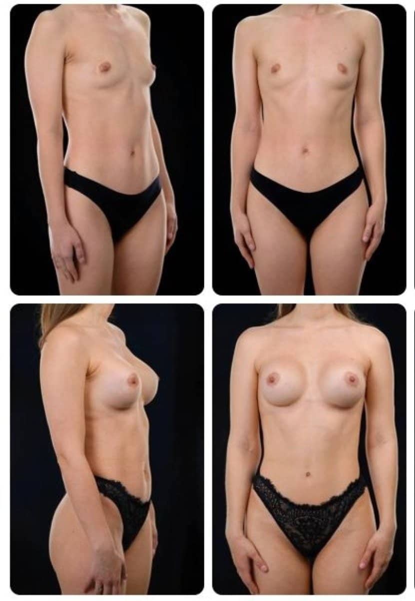 Case 14698 - breast augmentation