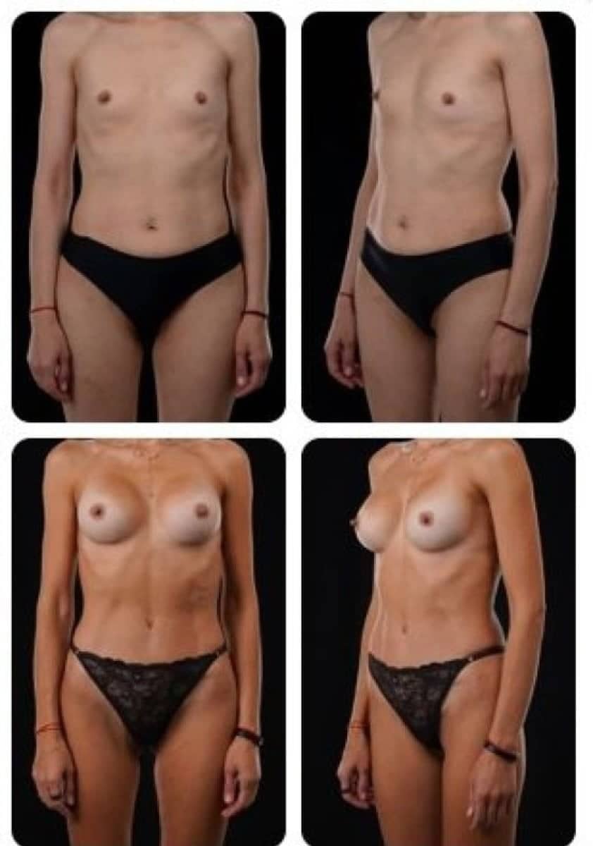 Case 14699 - breast augmentation