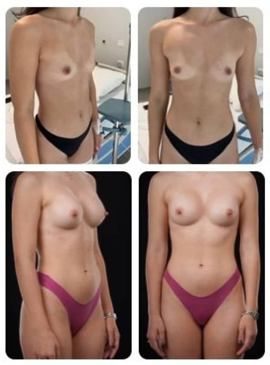 Case 14700 - breast augmentation