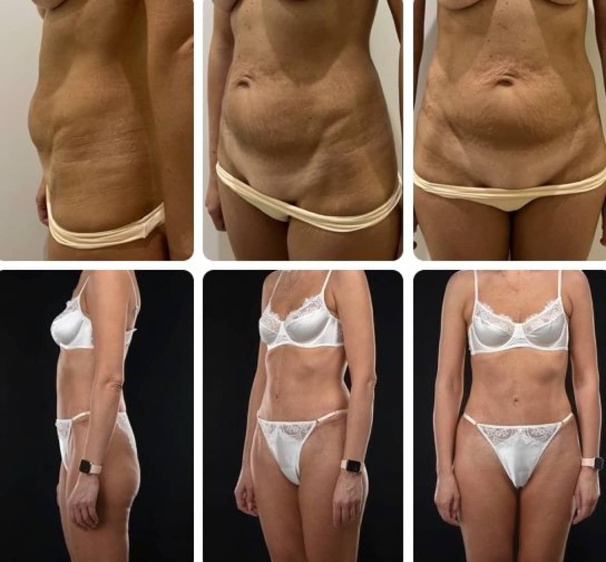 Case 14701 - liposuction