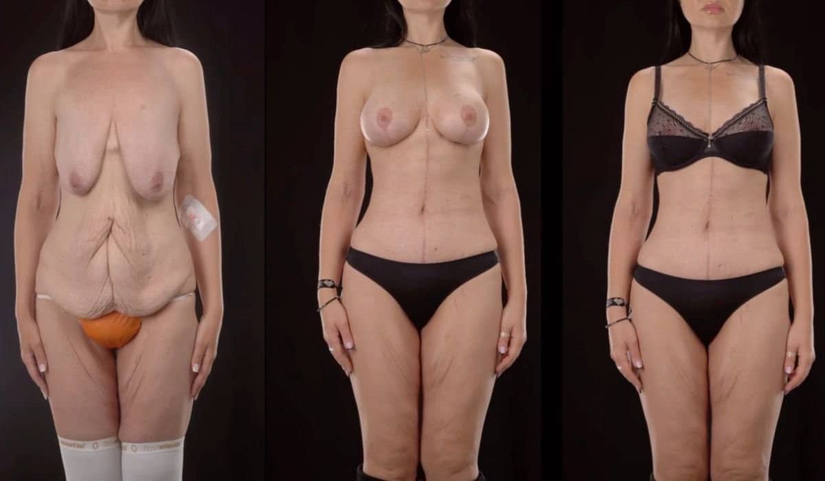 Case 14702 - liposuction and body contouring