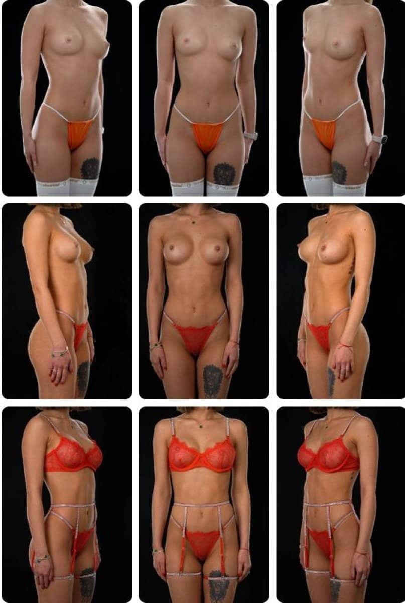 Case 14703 - breast augmentation