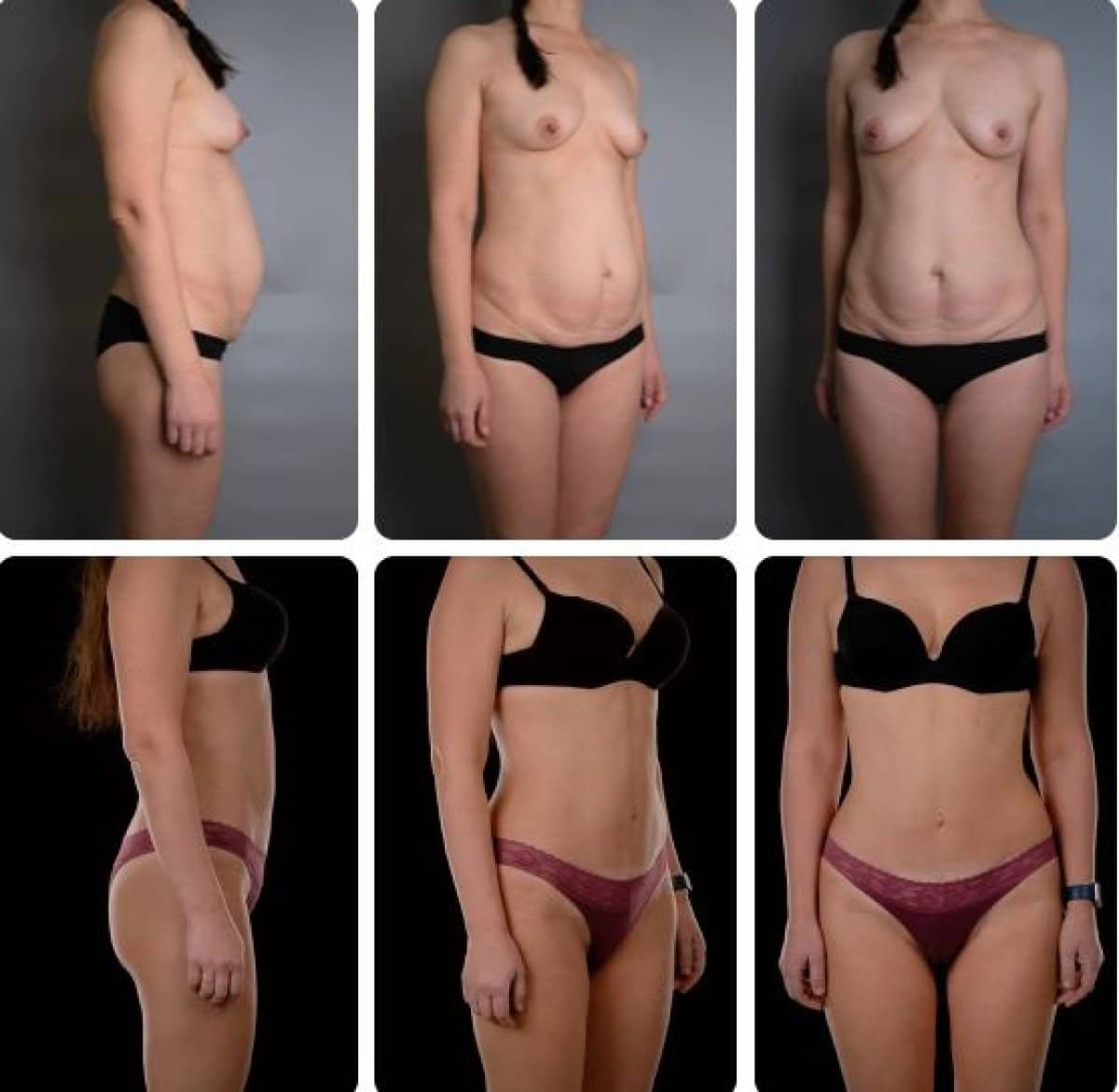 Case 14704 - liposuction