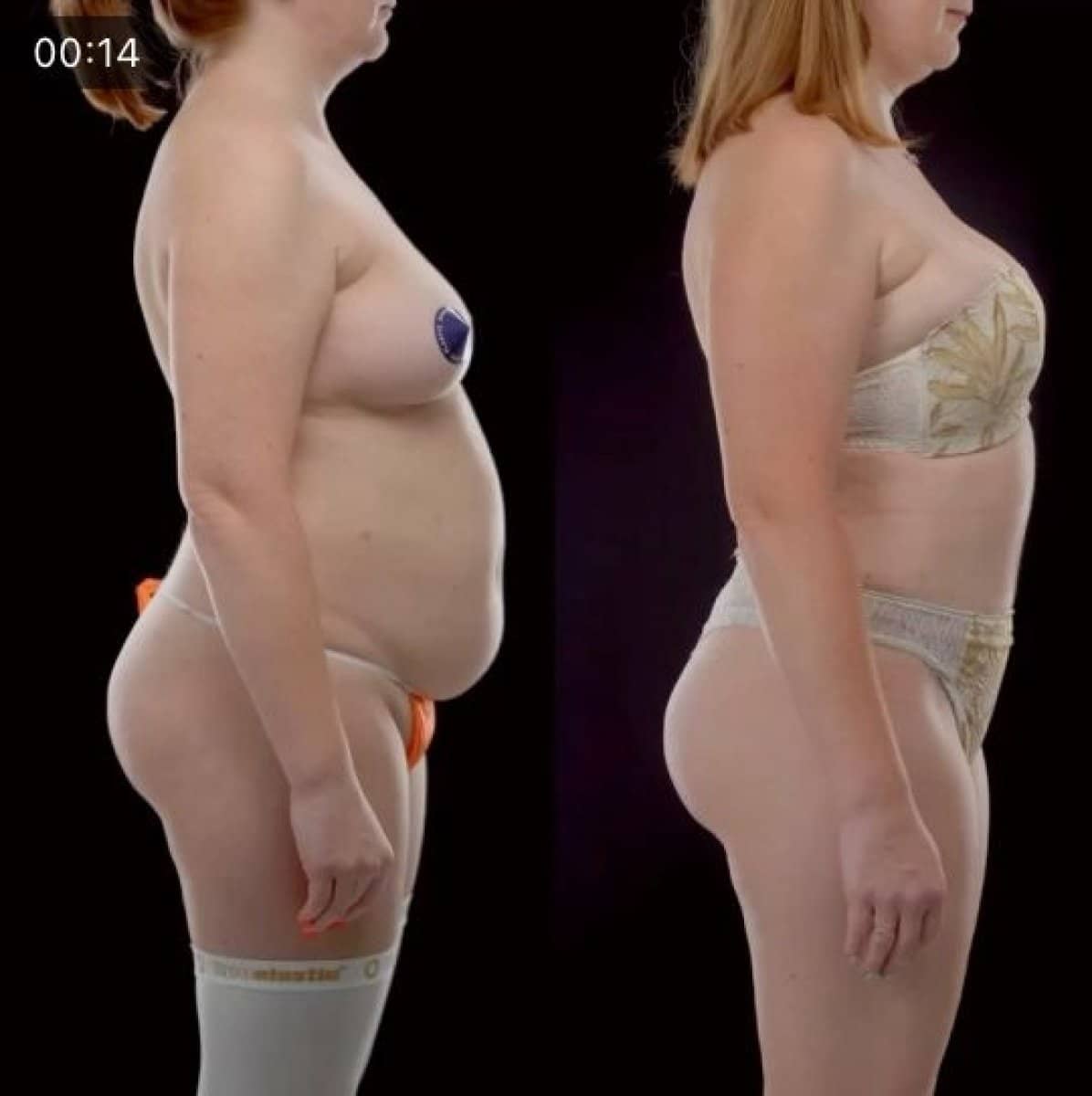 Case 14705 - liposuction