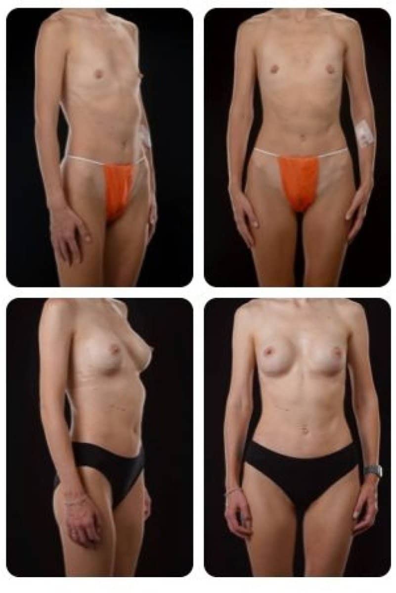 Case 14706 - breast augmentation
