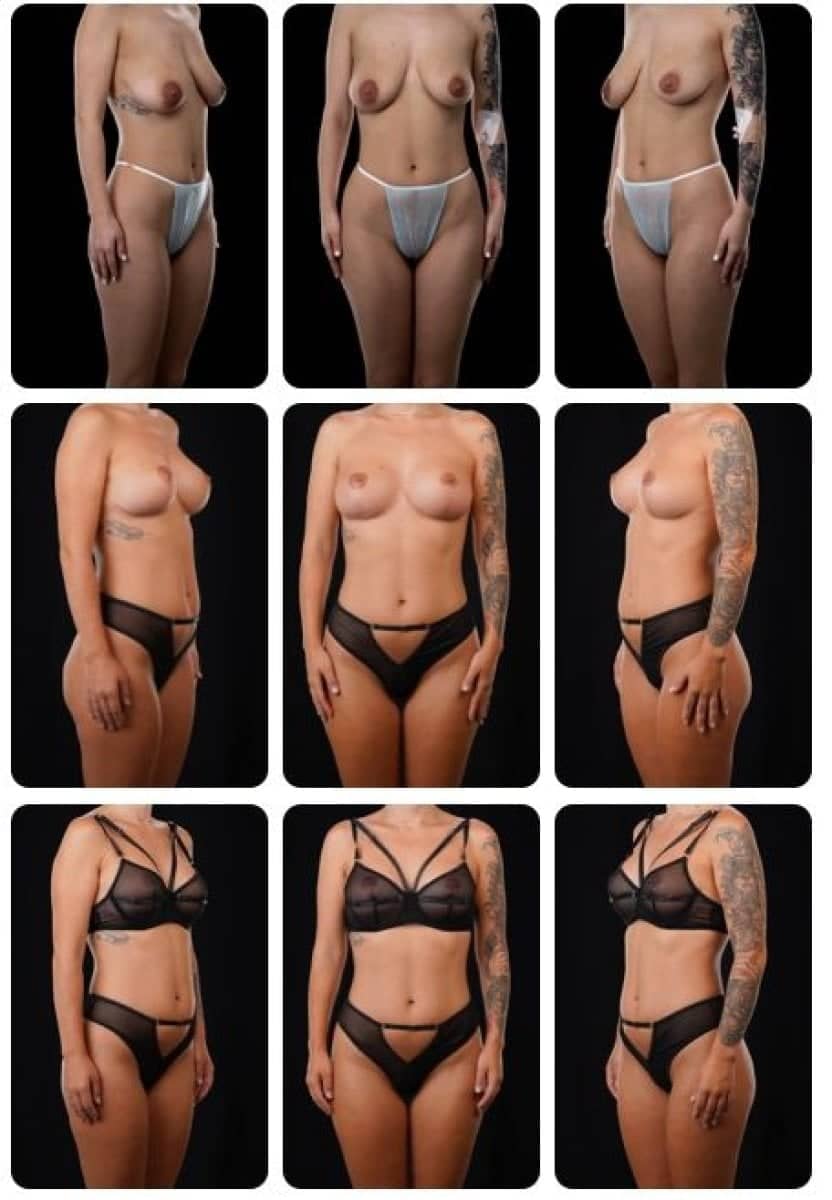 Case 14707 - breast lift