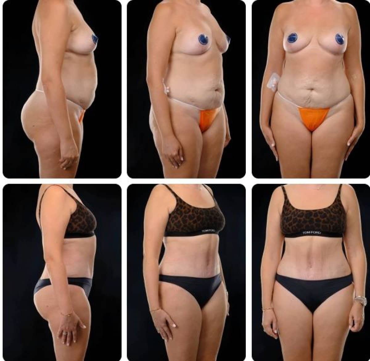 Case 14708 - liposuction