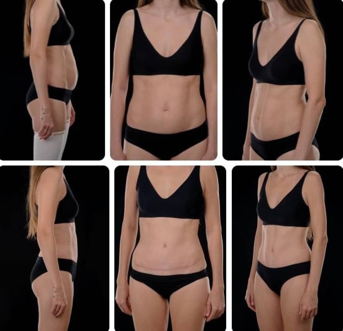 Case 14709 - liposuction