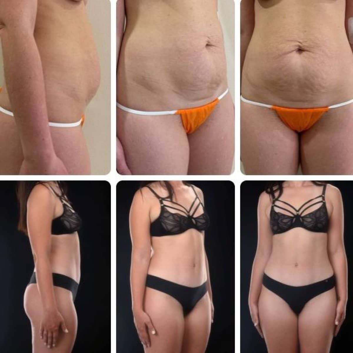 Case 14710 - liposuction