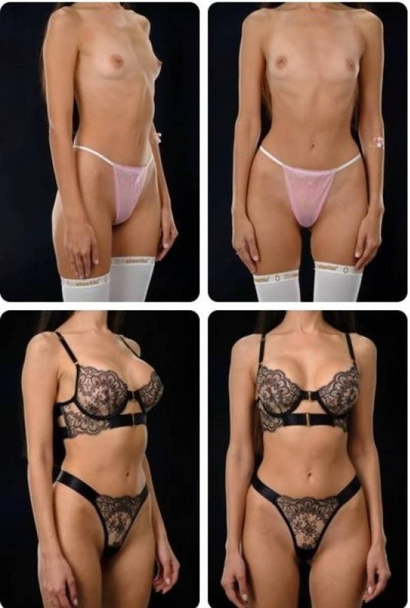 Case 14711 - breast augmentation