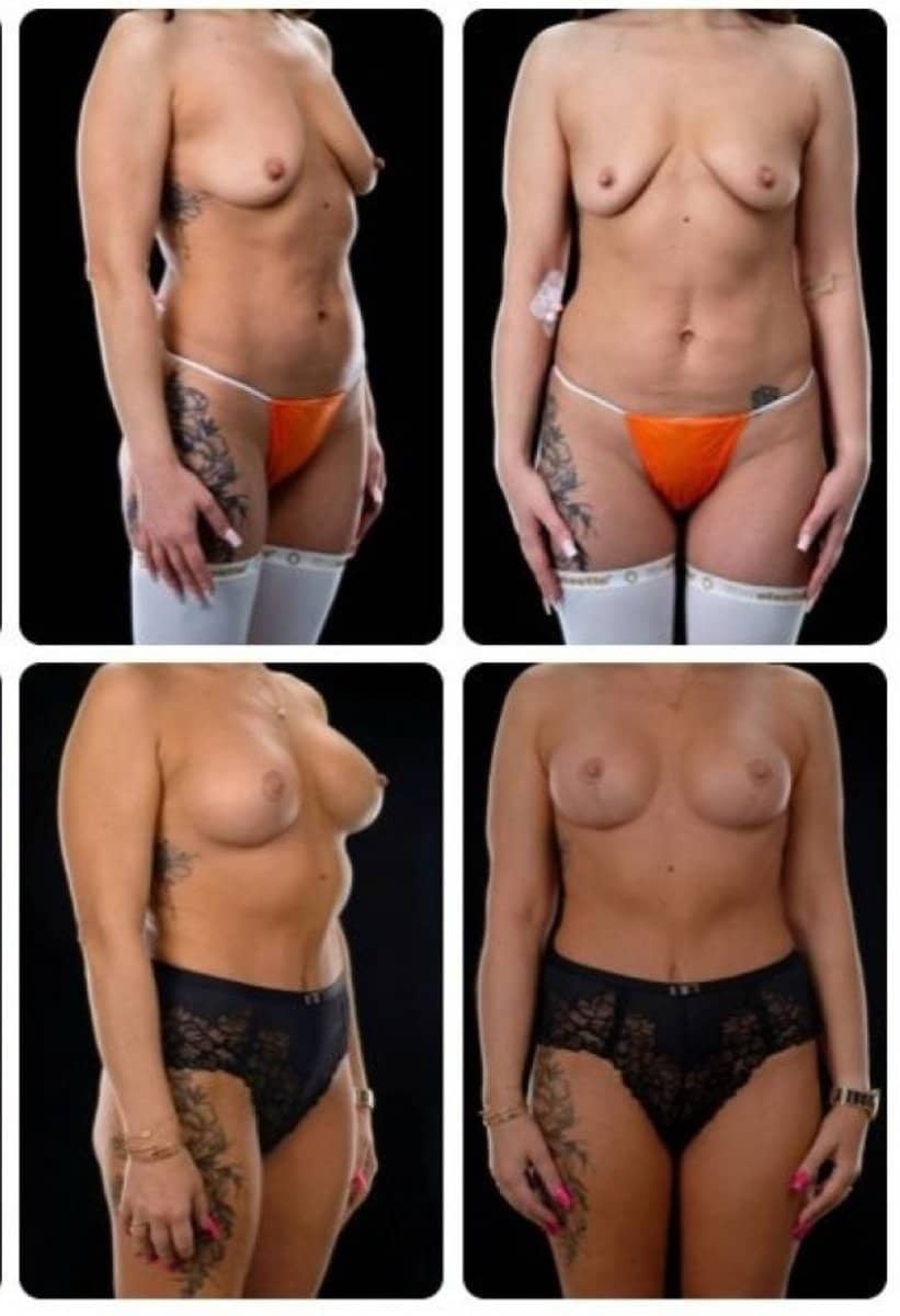 Case 14712 - breast lift