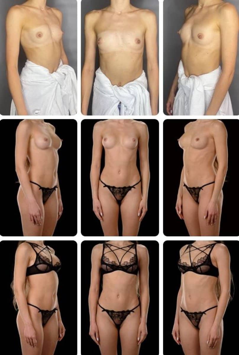 Case 14713 - breast augmentation