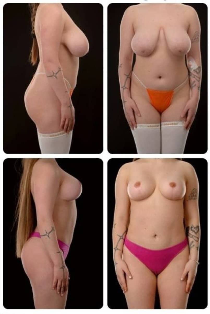 Case 14714 - breast lift