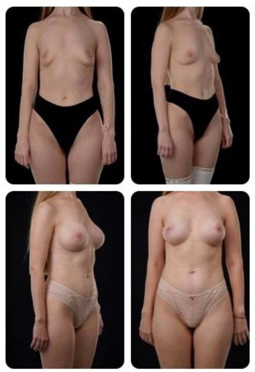 Case 14715 - breast augmentation