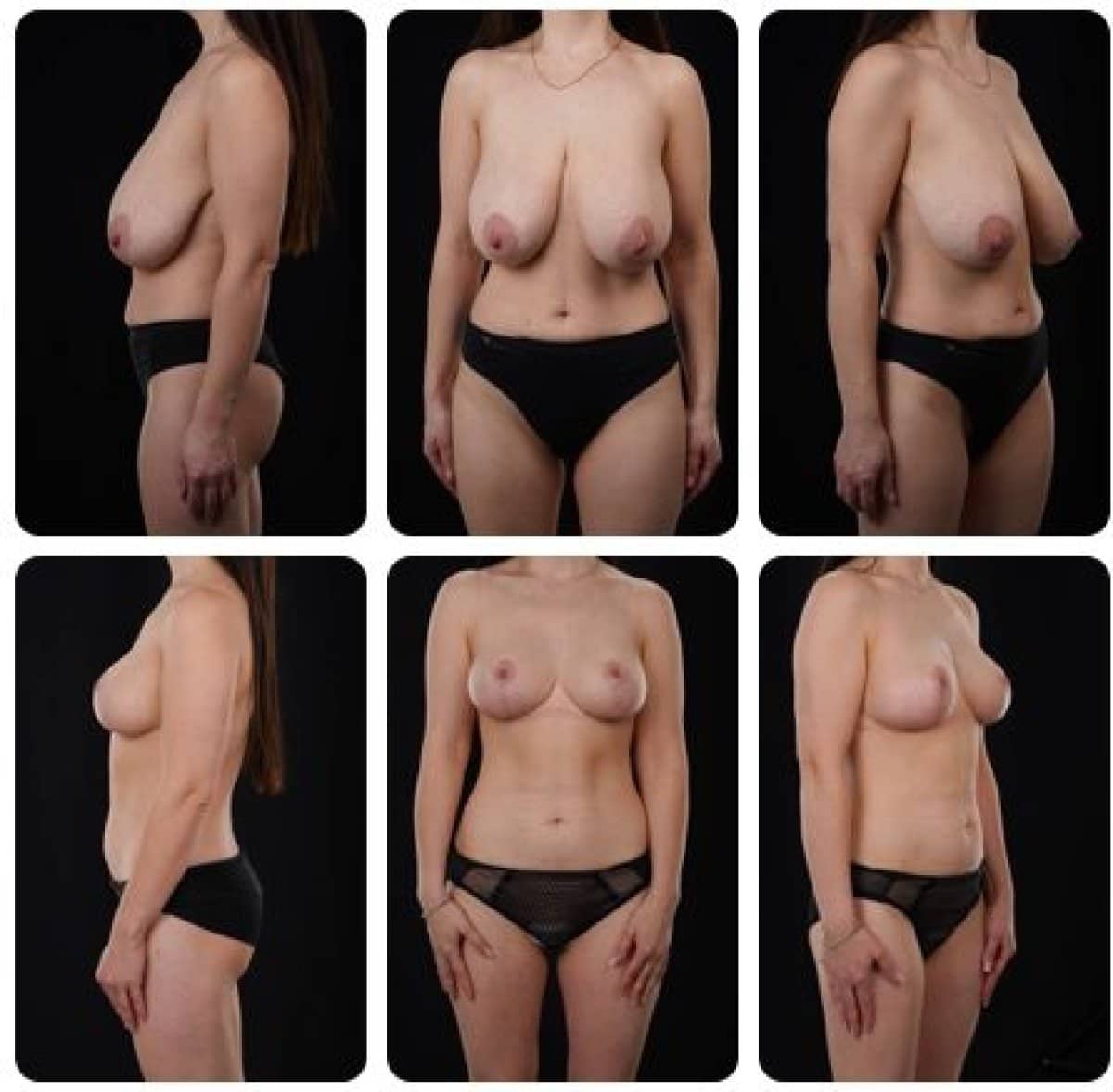 Case 14716 - breast lift