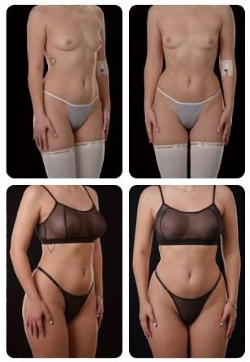 Case 14719 - breast augmentation