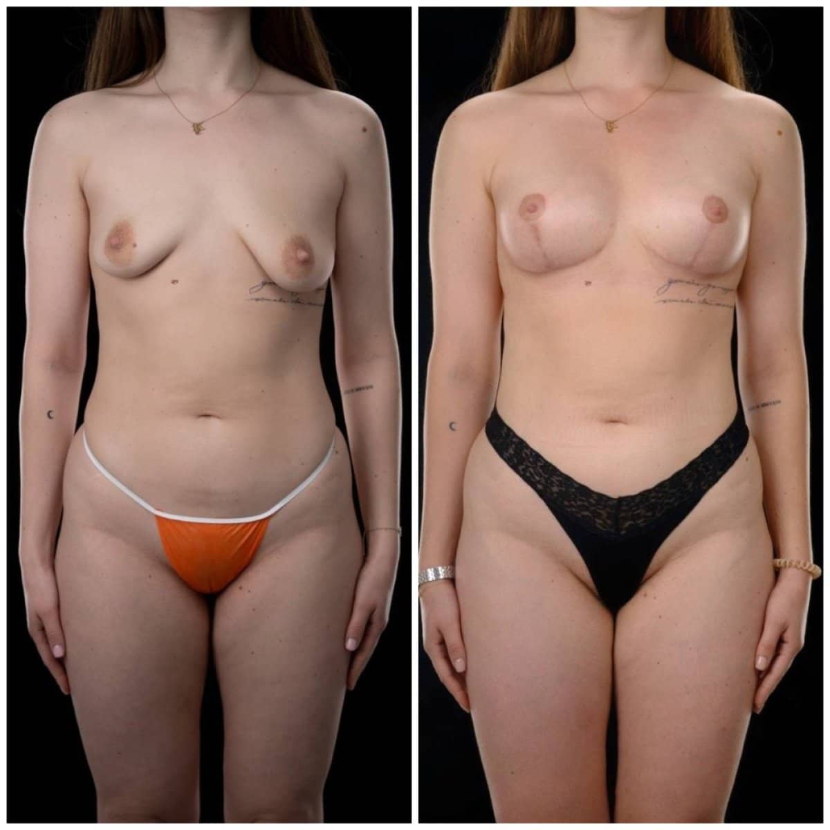 Case 14720 - breast augmentation