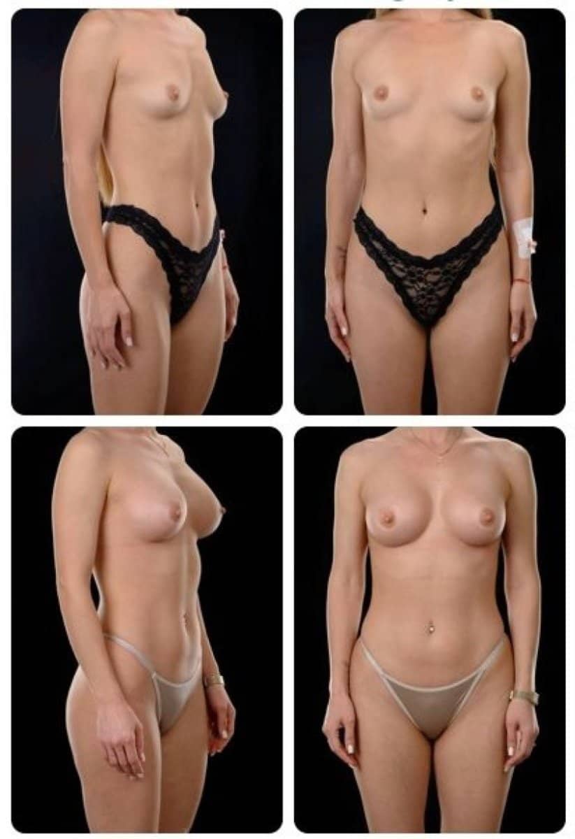 Case 14723 - breast augmentation