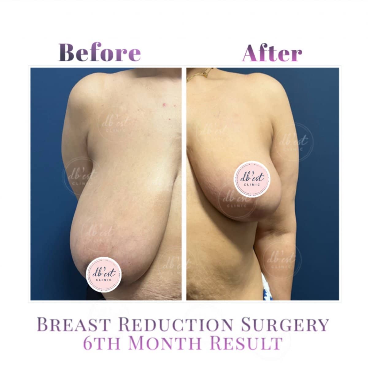 Case 14729 - at Db'est Clinic – 6 month
