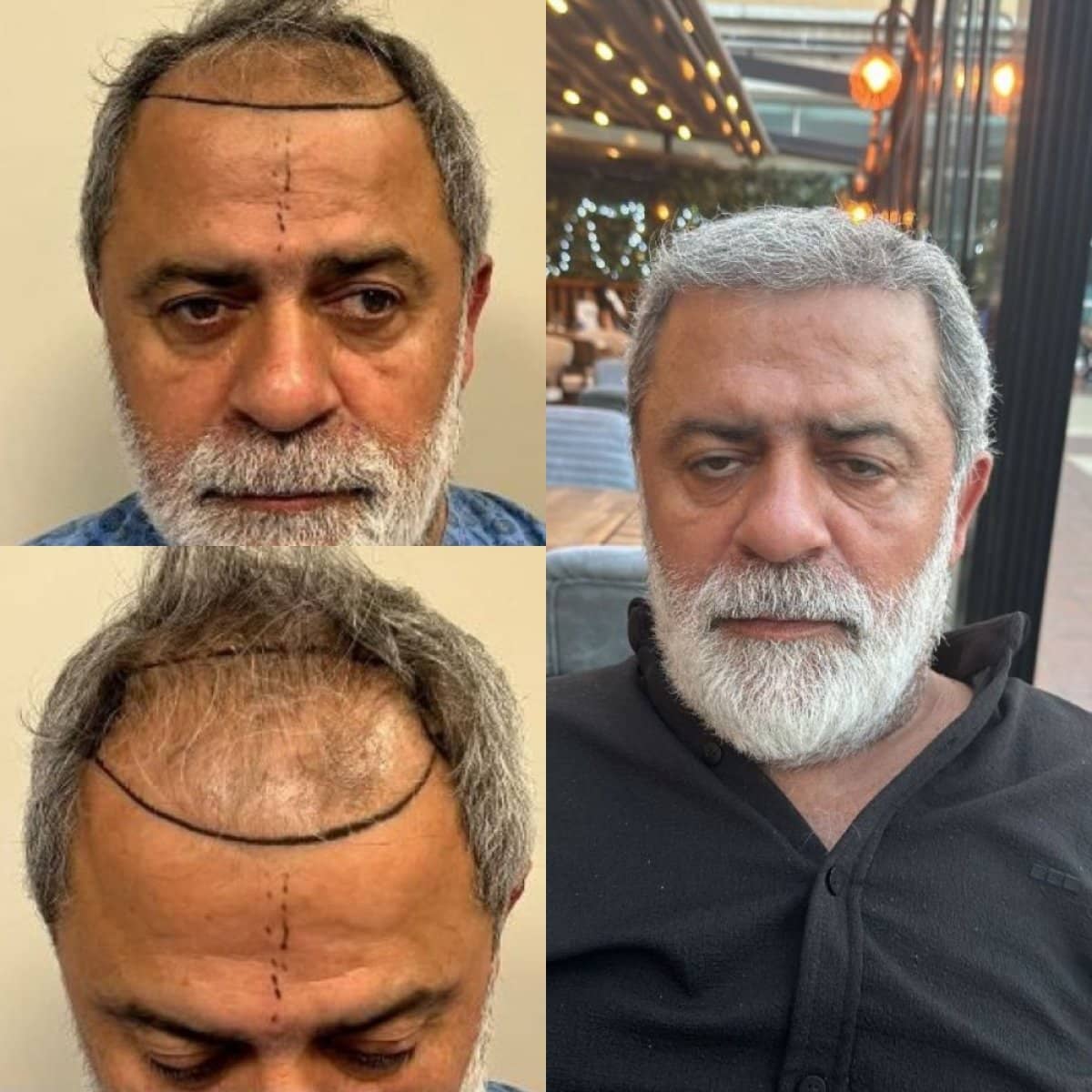 Case 14756 - FUE hair transplant