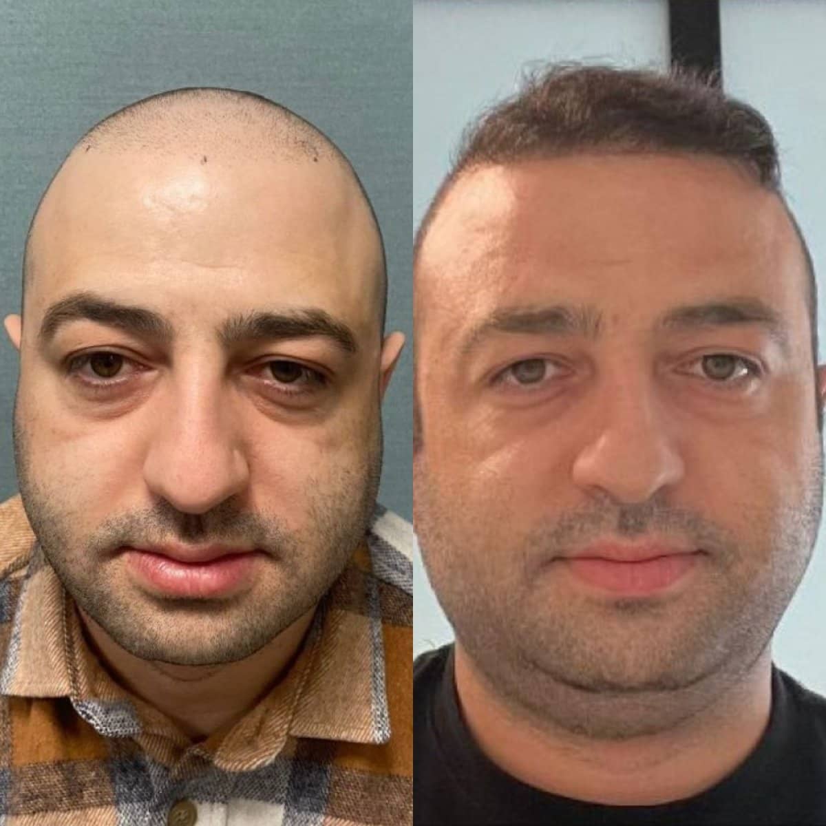Case 14757 - FUE hair transplant