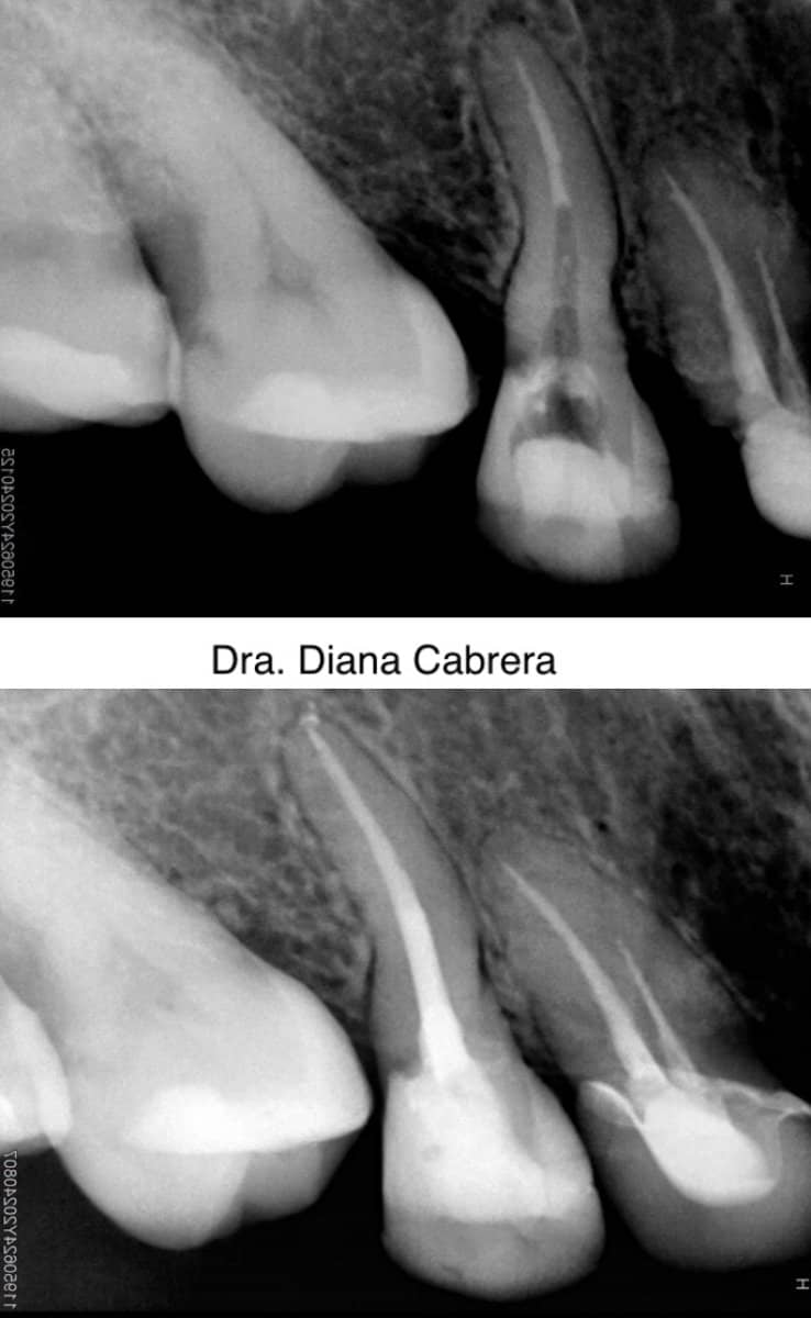 Case 14759 - root canal treatment
