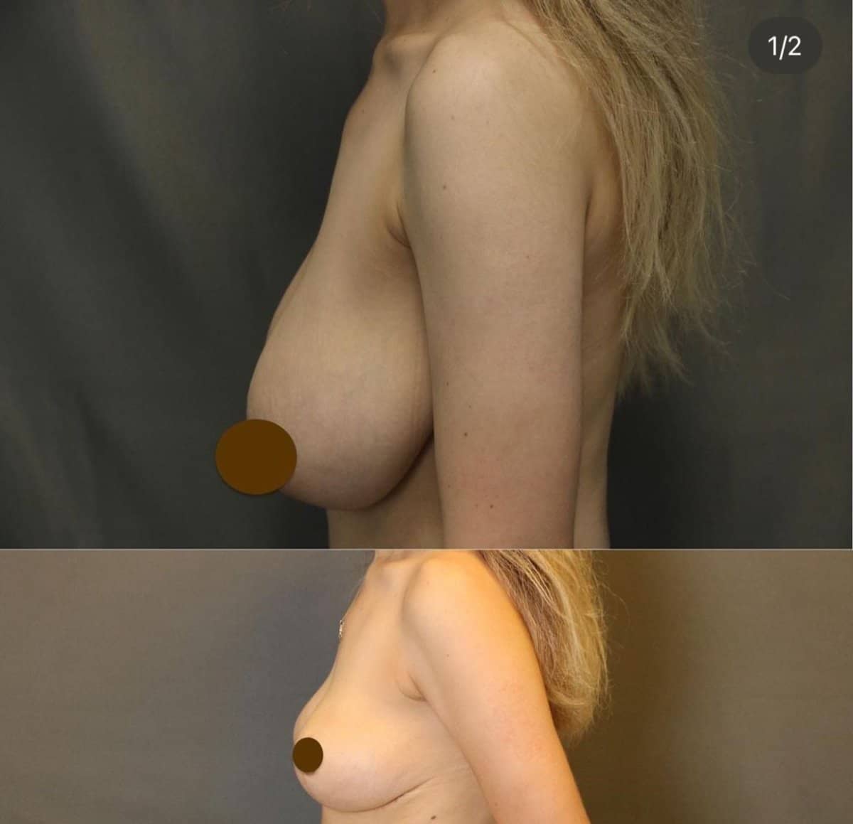 Case 14761 - breast reconstruction surgery
