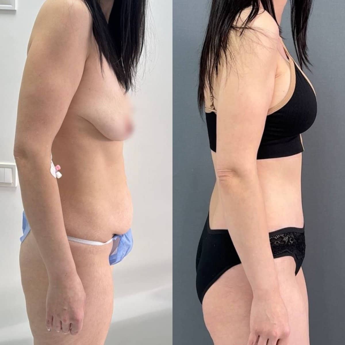Case 14764 - breast lift