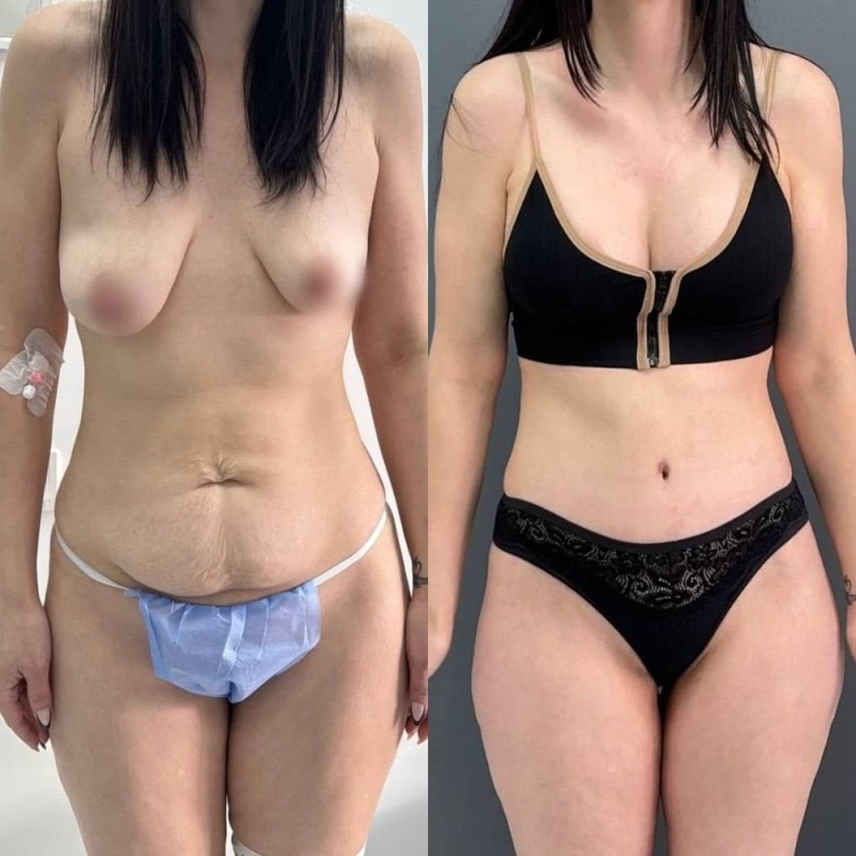 Case 14765 - liposuction