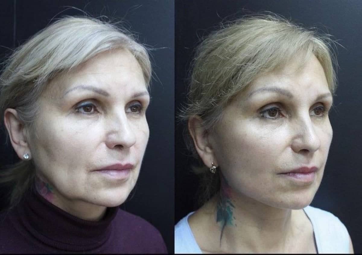 Case 14767 - neck lift